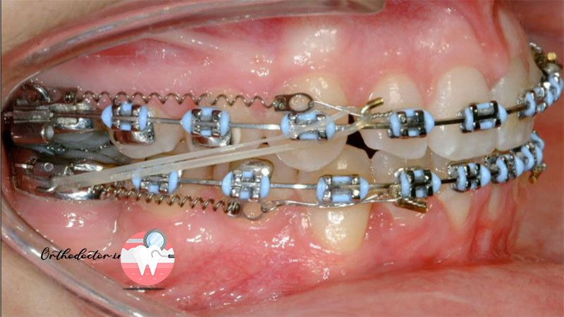 ارتودنسی عقب بردن فک